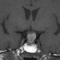 Craniopharyngiome