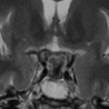 Craniopharyngiome