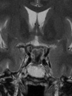 Craniopharyngiome