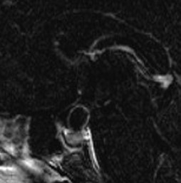 Craniopharyngiome