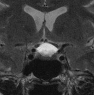 Craniopharyngiome