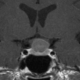 Craniopharyngiome