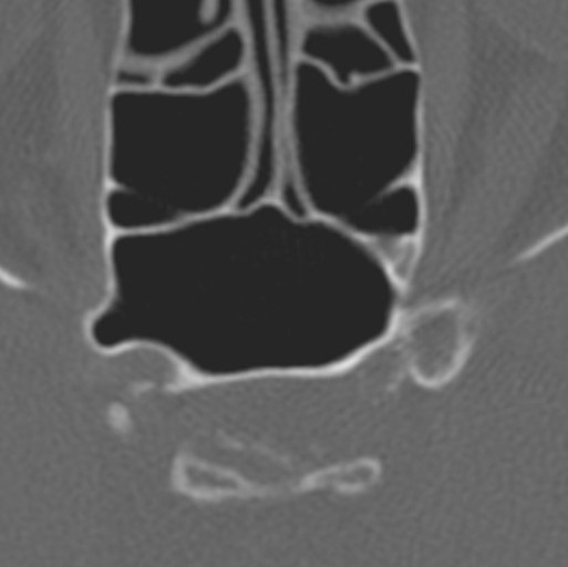 Craniopharyngiome