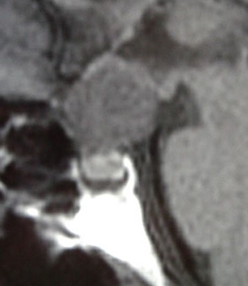 Craniopharyngiome