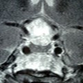 Craniopharyngiome