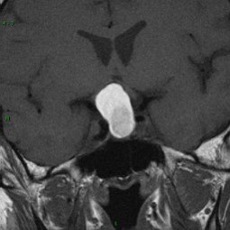 Craniopharyngiome