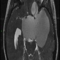 Craniopharyngiome