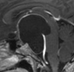 Craniopharyngiome