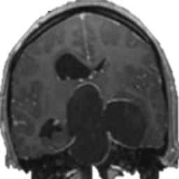 Craniopharyngiome