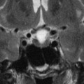 Craniopharyngiome