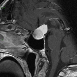 Craniopharyngiome