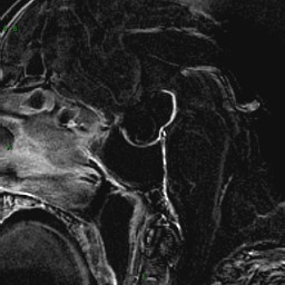 Craniopharyngiome