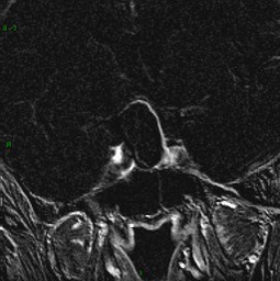 Craniopharyngiome