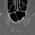 Craniopharyngiome