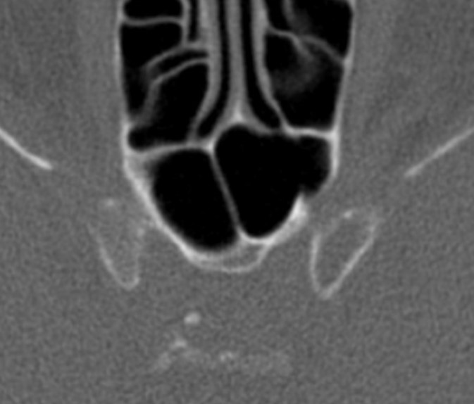 Craniopharyngiome