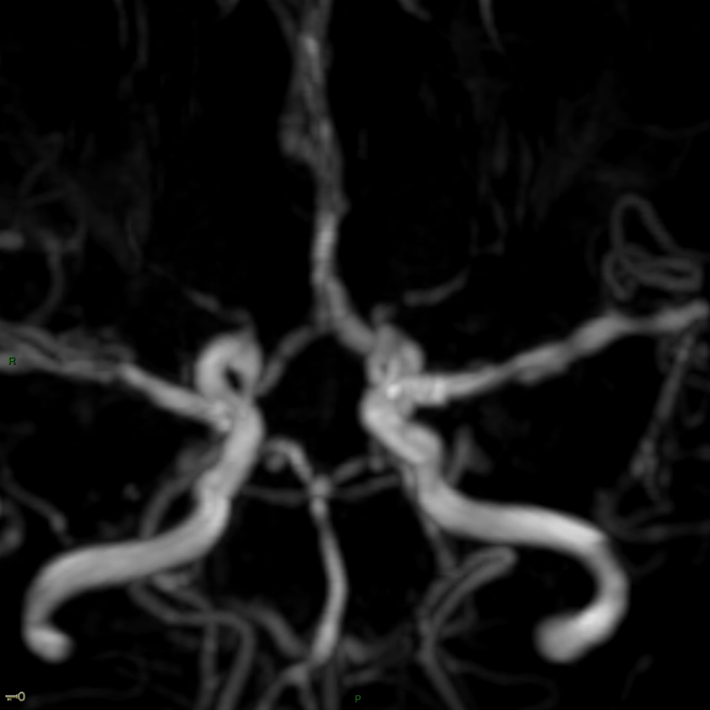 Syndrome de vasoconstriction réversible