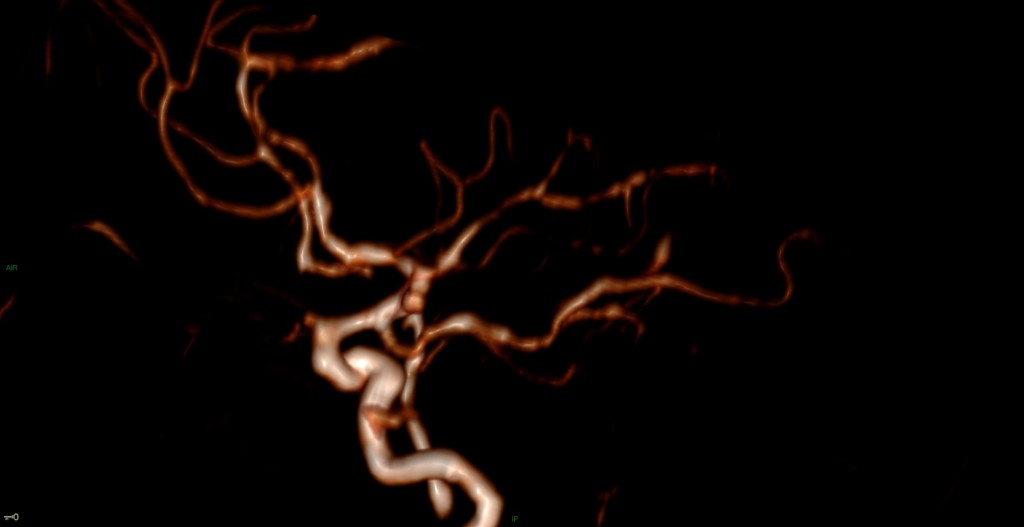 Syndrome de vasoconstriction réversible