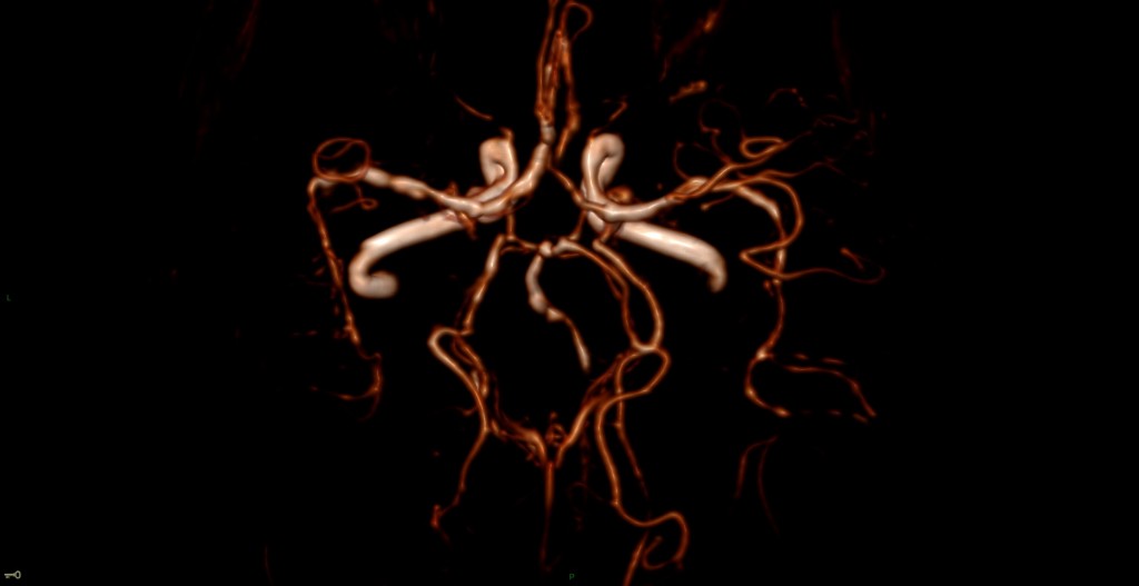 Syndrome de vasoconstriction réversible