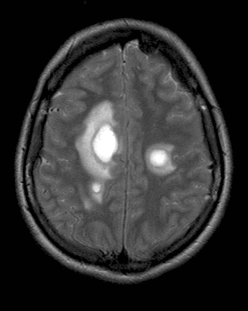 Sclérose en plaque et pathologies démyélinisantes – PinkyBone