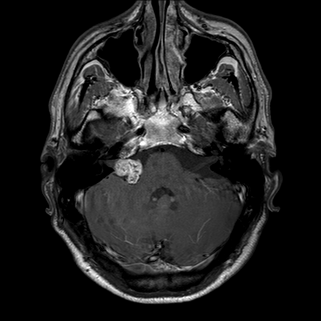 Schwannome vestibulaire AXT1IV+