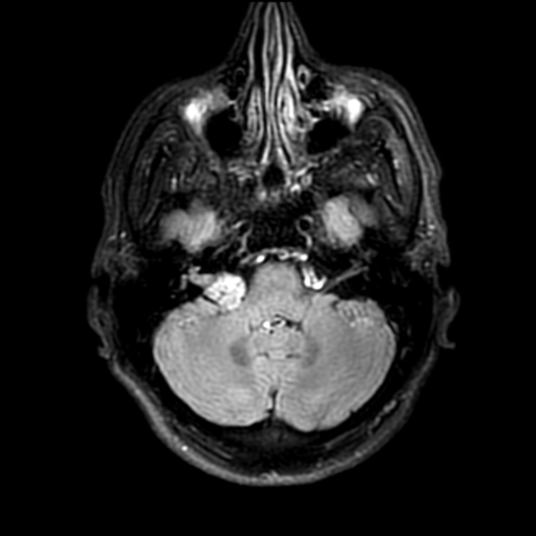 Schwannome vestibulaire FLAIR