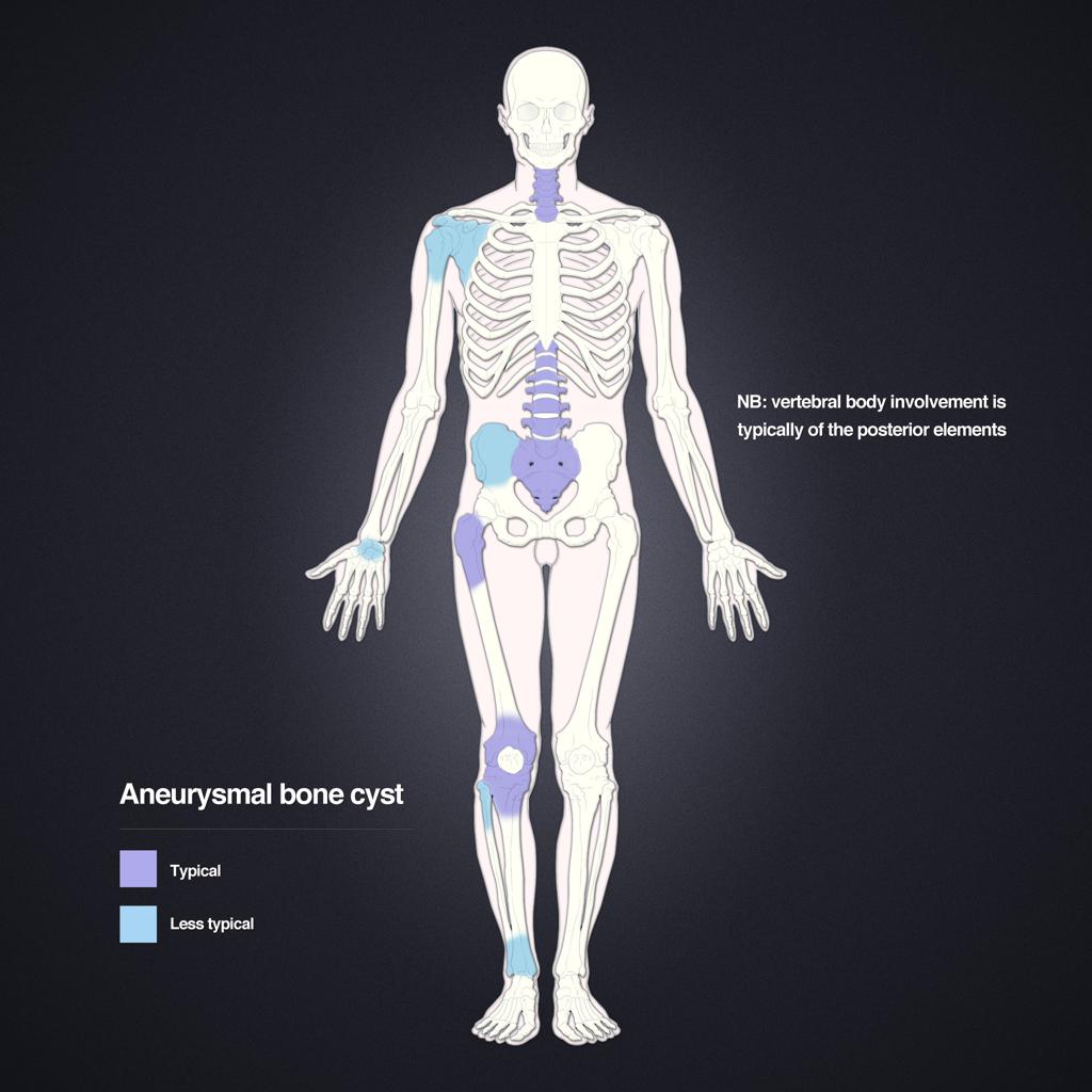Kyste osseux anévrismal