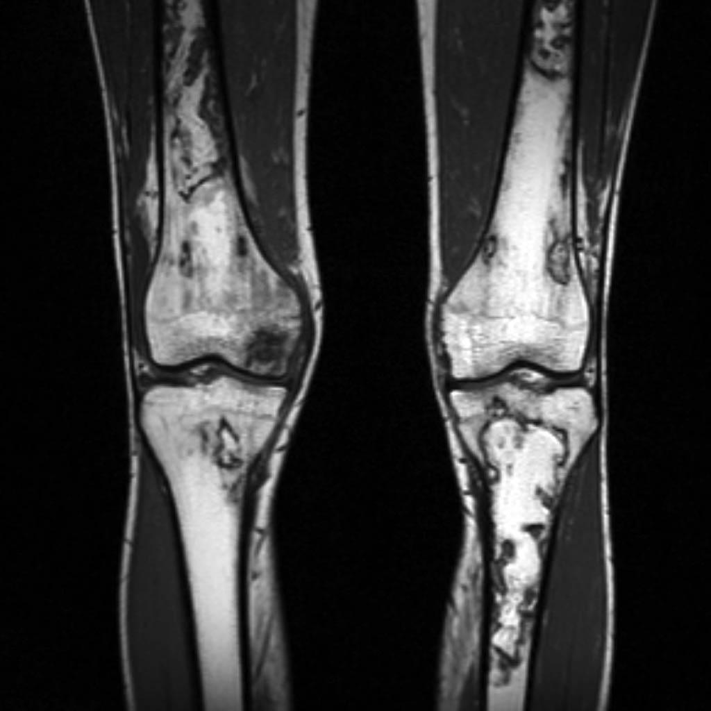 Infarctus osseux