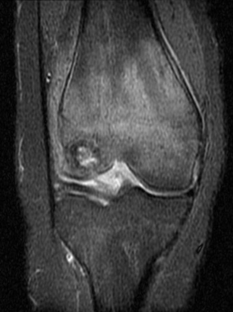 Chondroblastome