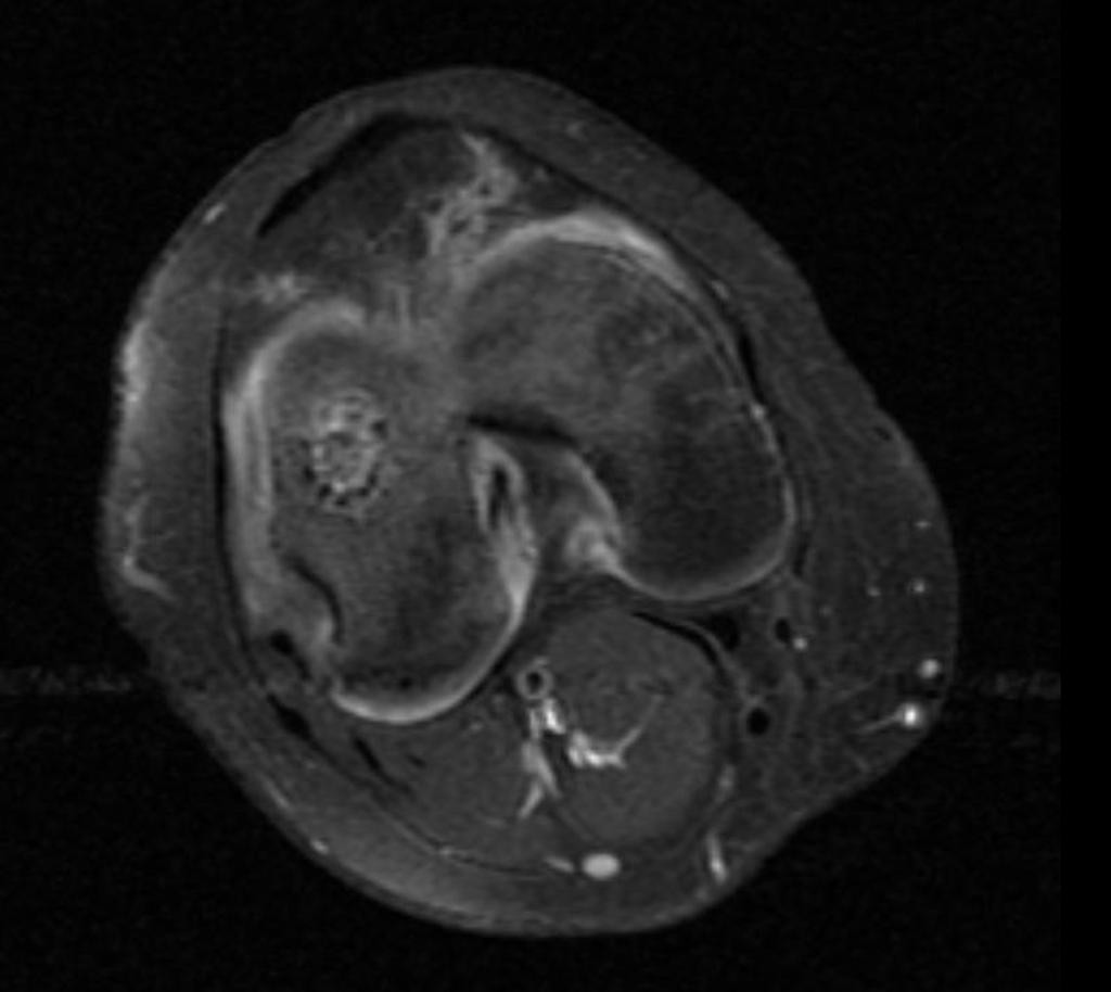 Chondroblastome