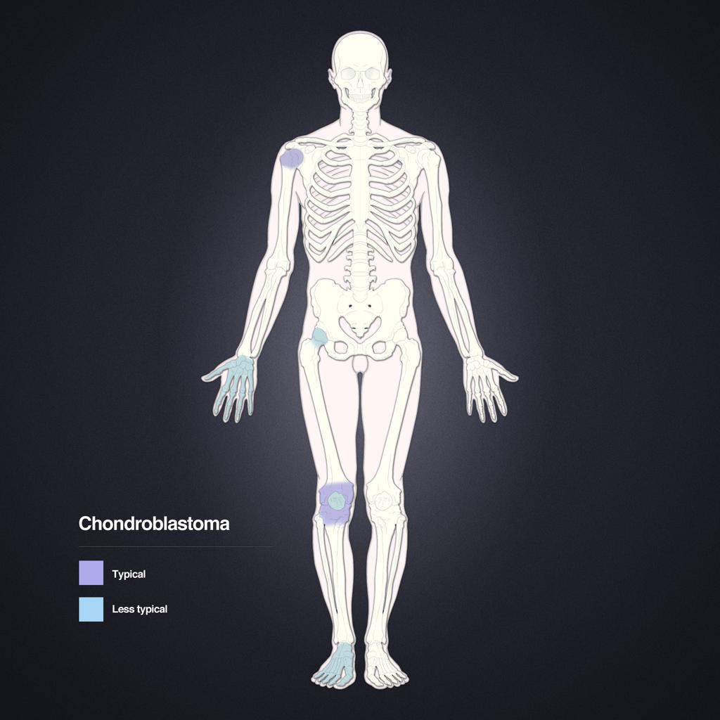 Chondroblastome