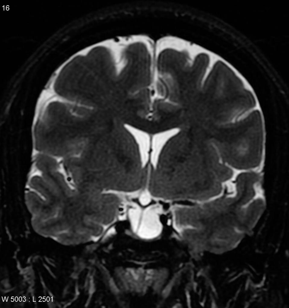 Hypertension intracranienne idiopathique