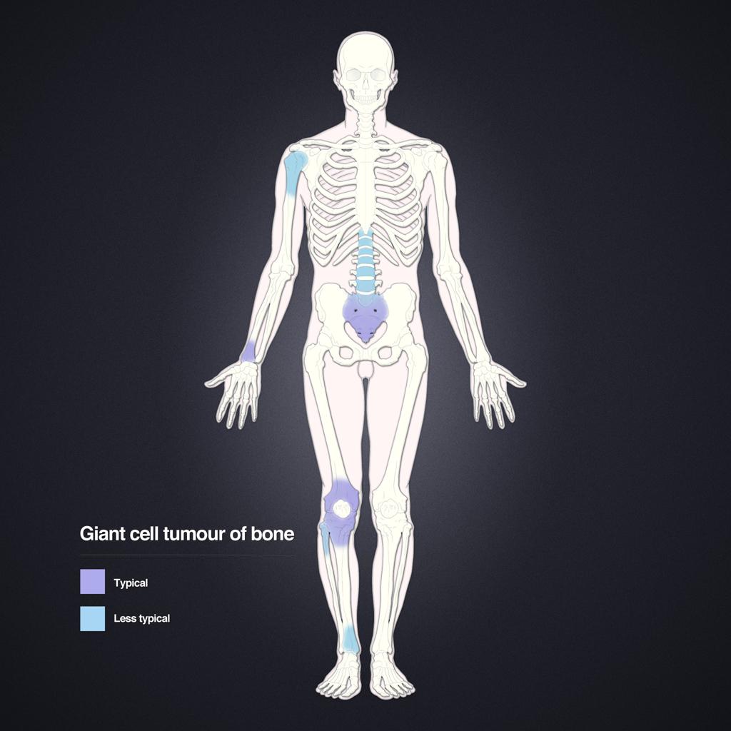 Tumeur à cellules géantes