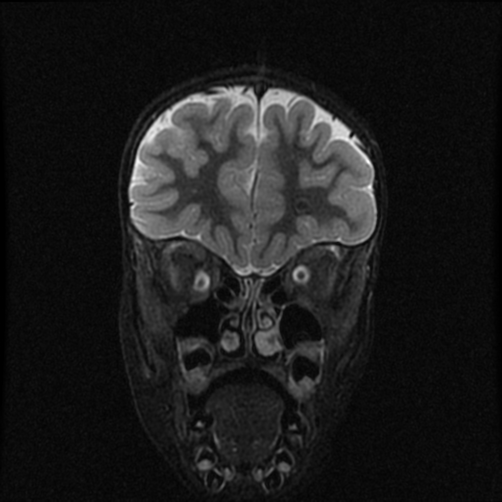 Hypertension intracranienne idiopathique