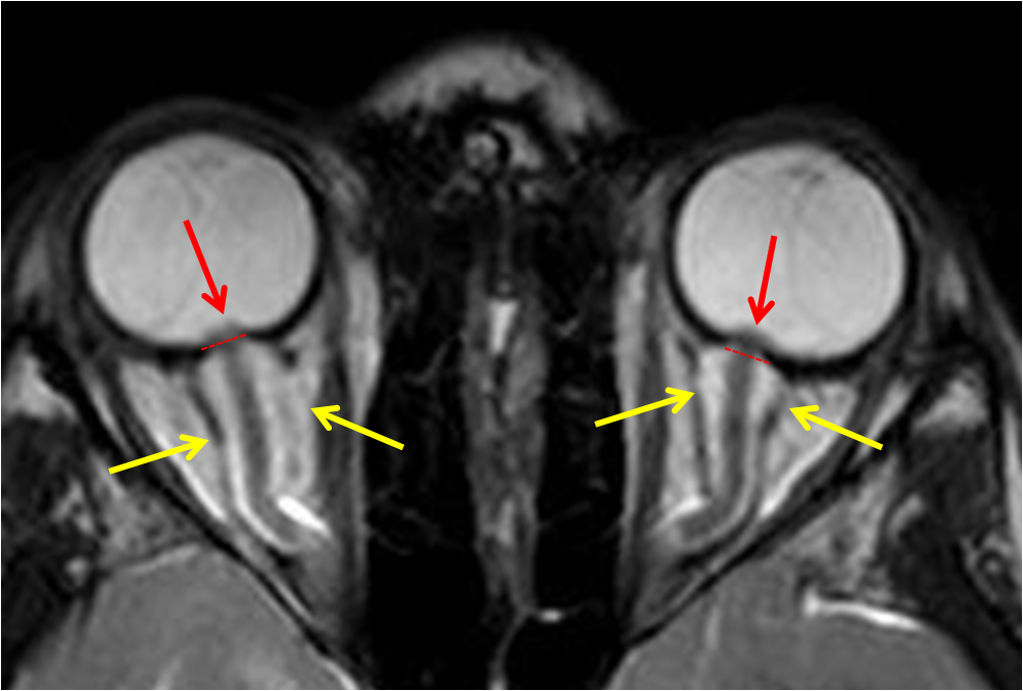 Hypertension intracranienne idiopathique