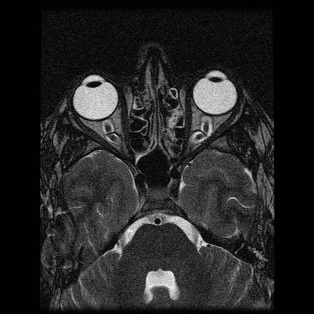 Hypertension intracranienne idiopathique