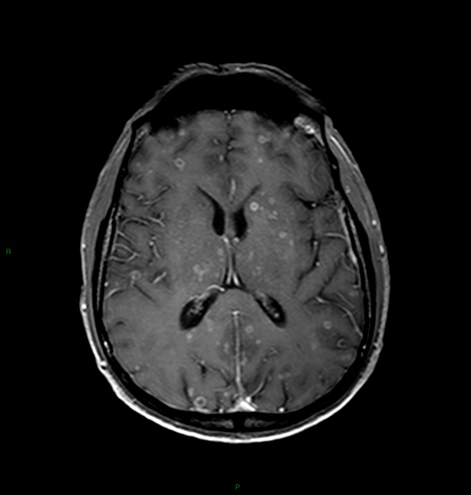 Tumeurs neuro – Métastases – PinkyBone