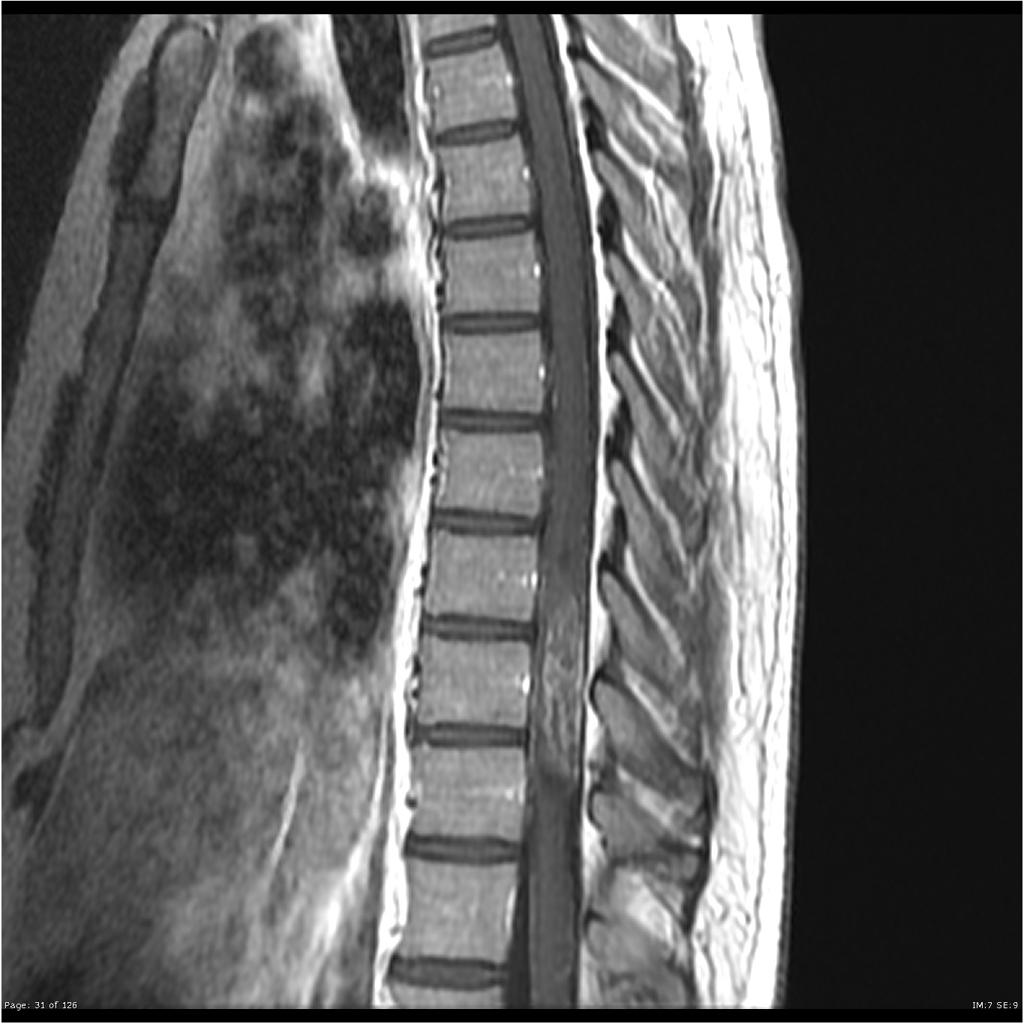 Tumeurs neuro – Rachidiennes intra-canalaires [algorithme] – PinkyBone