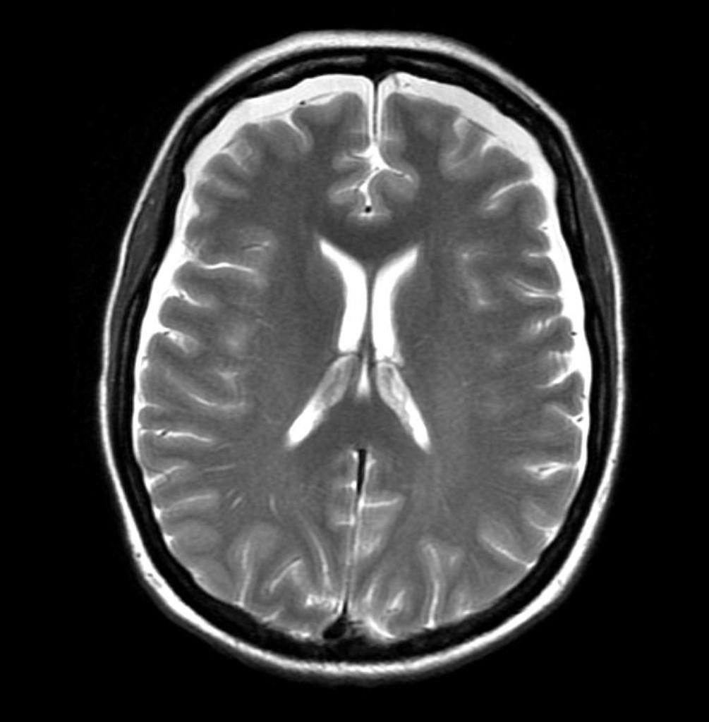 Hypotension intracranienne