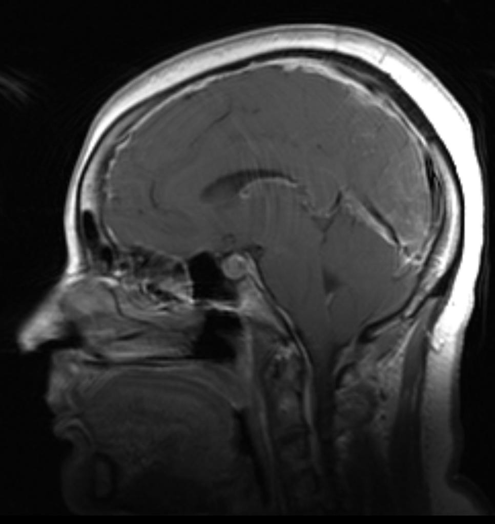 Hypotension intracranienne