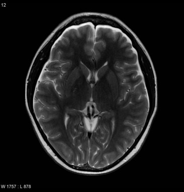 Hypotension intracranienne – PinkyBone