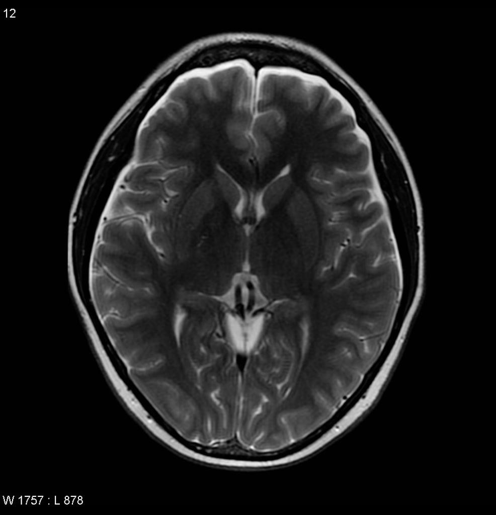 Hypotension intracranienne