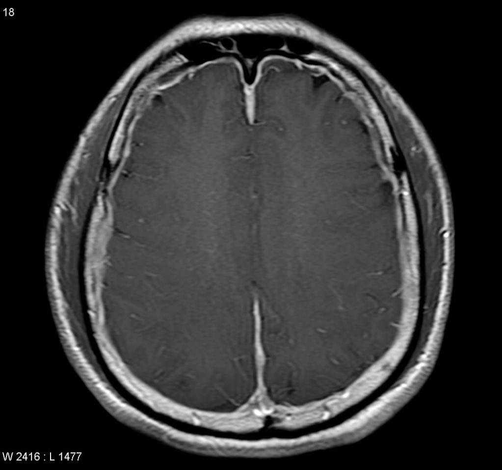 Hypotension intracranienne