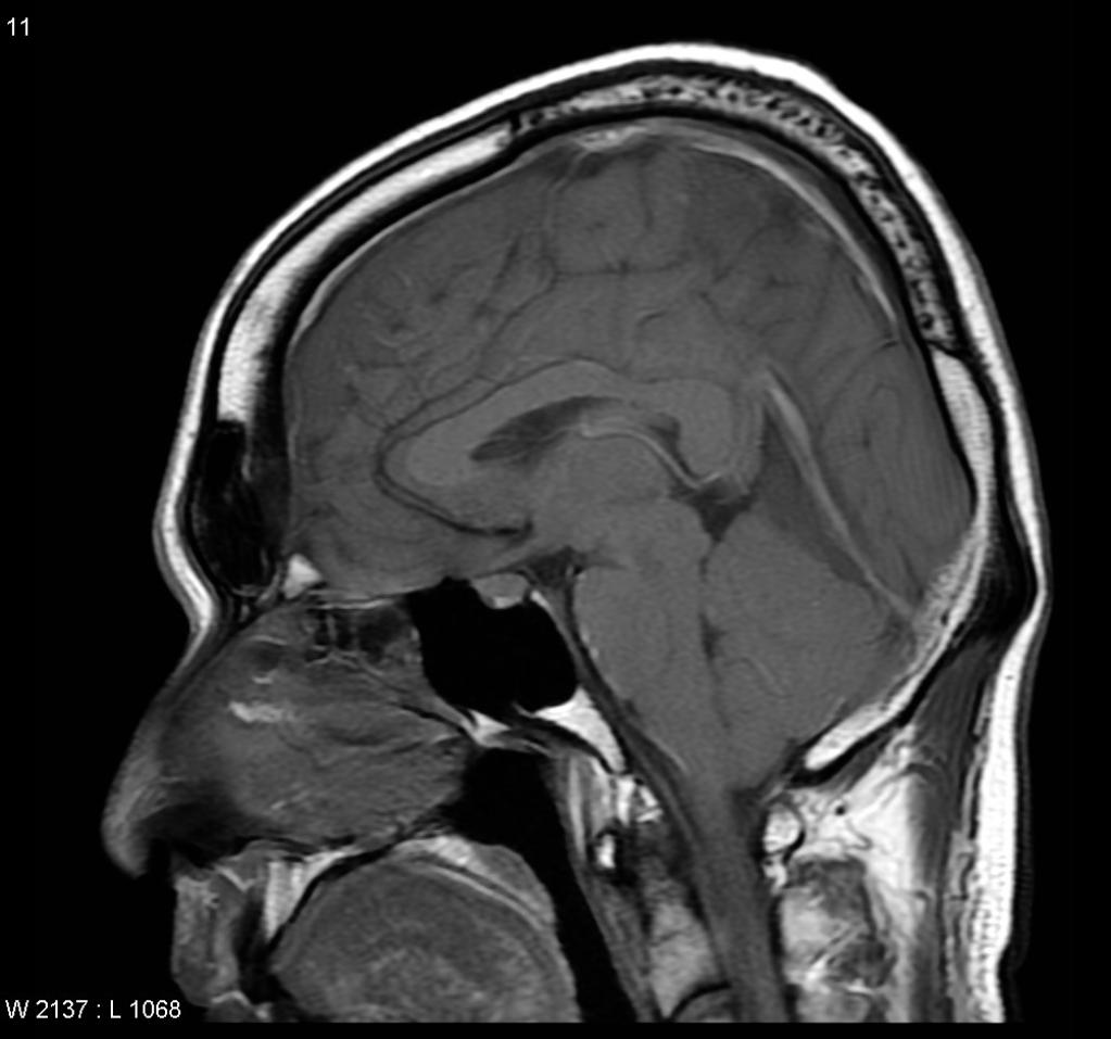 Hypotension intracranienne