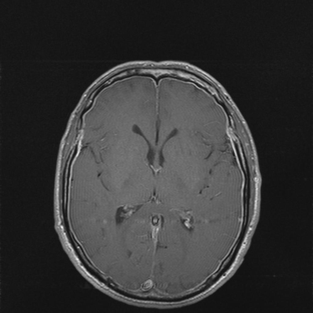 Hypotension intracranienne