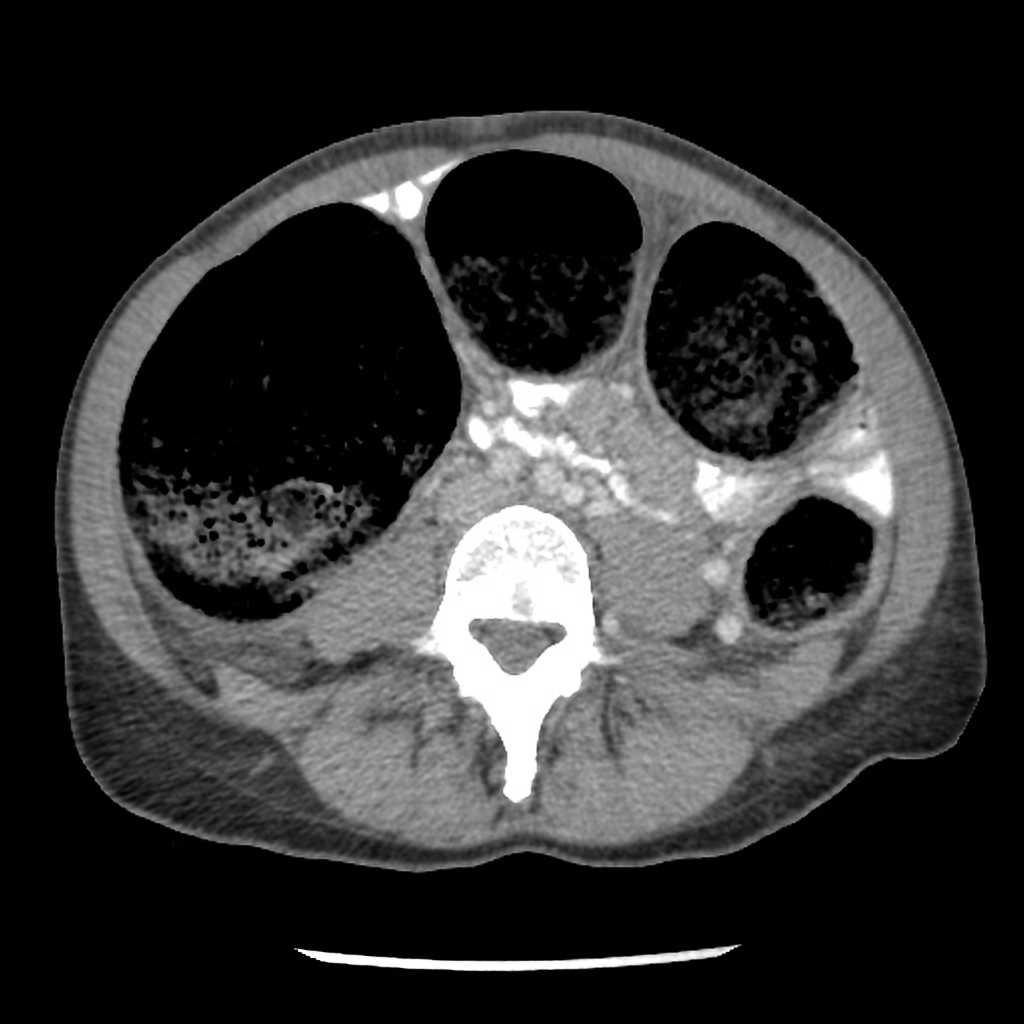 Case courtesy of Dr Thuan Tzen, Koh, Radiopaedia.org. From the case rID: 34747