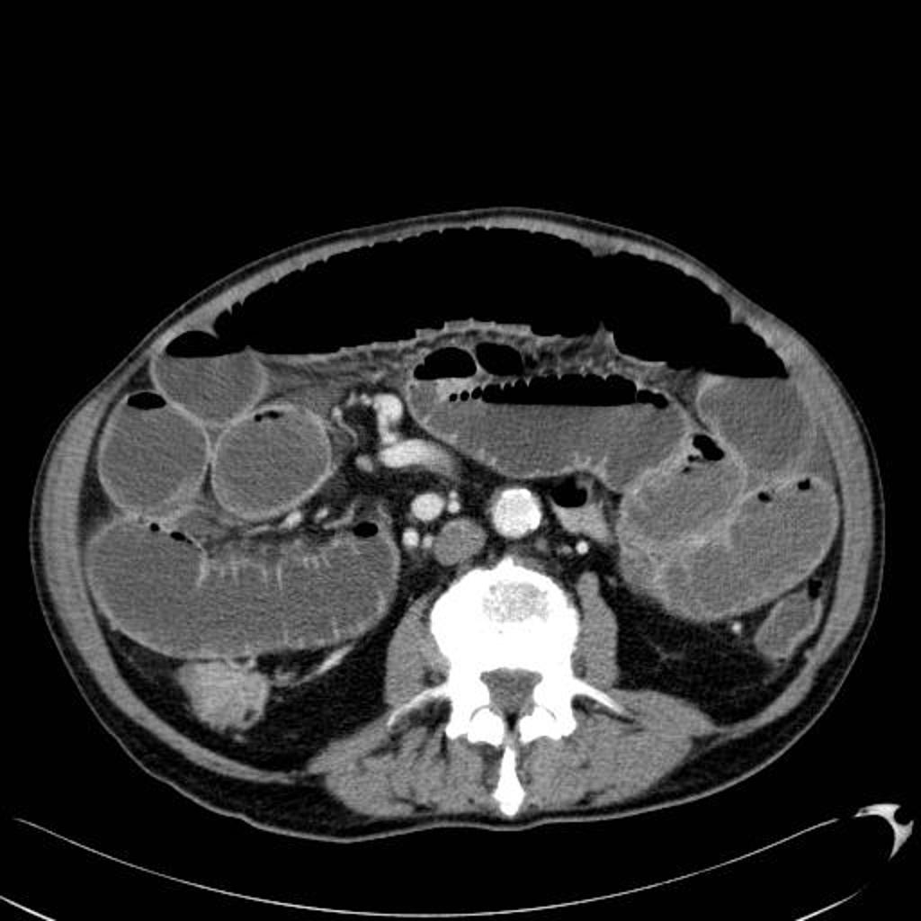 Case courtesy of Dr Jeremy Jones, Radiopaedia.org. From the case rID: 6135