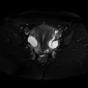 Case courtesy of Dr Roberto Schubert, Radiopaedia.org. From the case rID: 17761