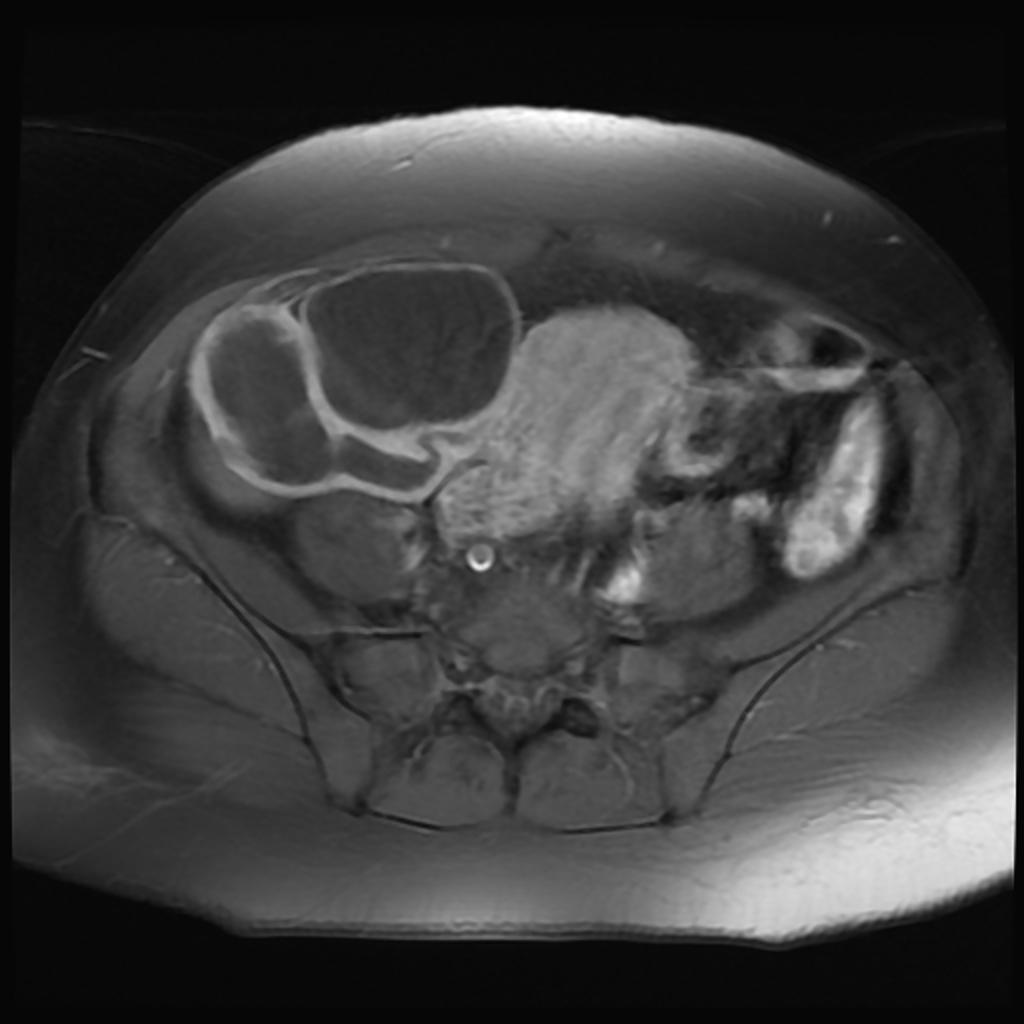 Case courtesy of Dr Mohammad A. ElBeialy, Radiopaedia.org. From the case rID: 23820