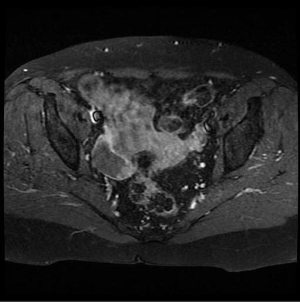 Case courtesy of Radiopaedia.org. From the case rID: 11817