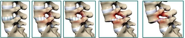 spondylo